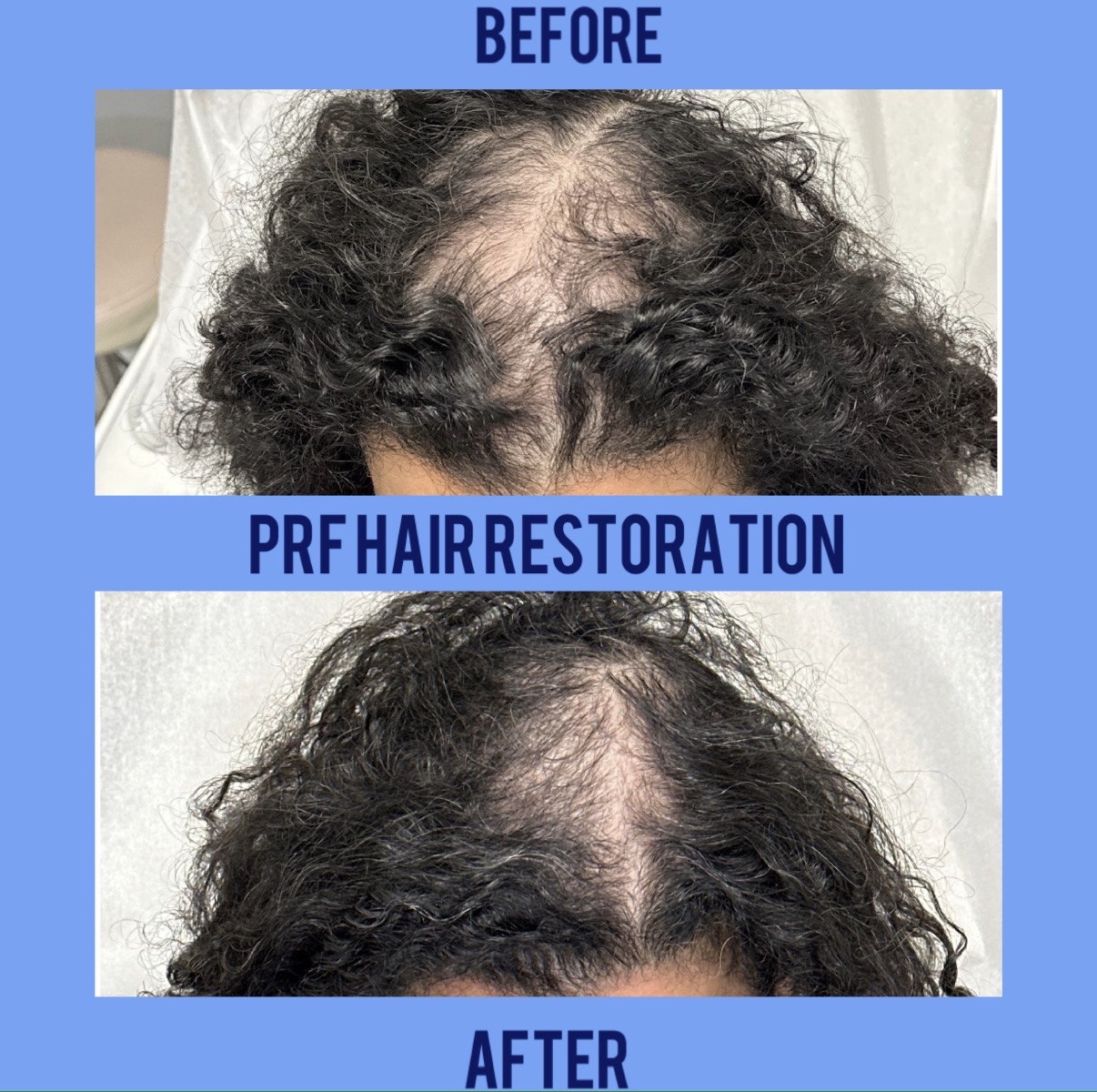 PRF hair restoration before and after results at On-Point Aesthetics, Boca Raton