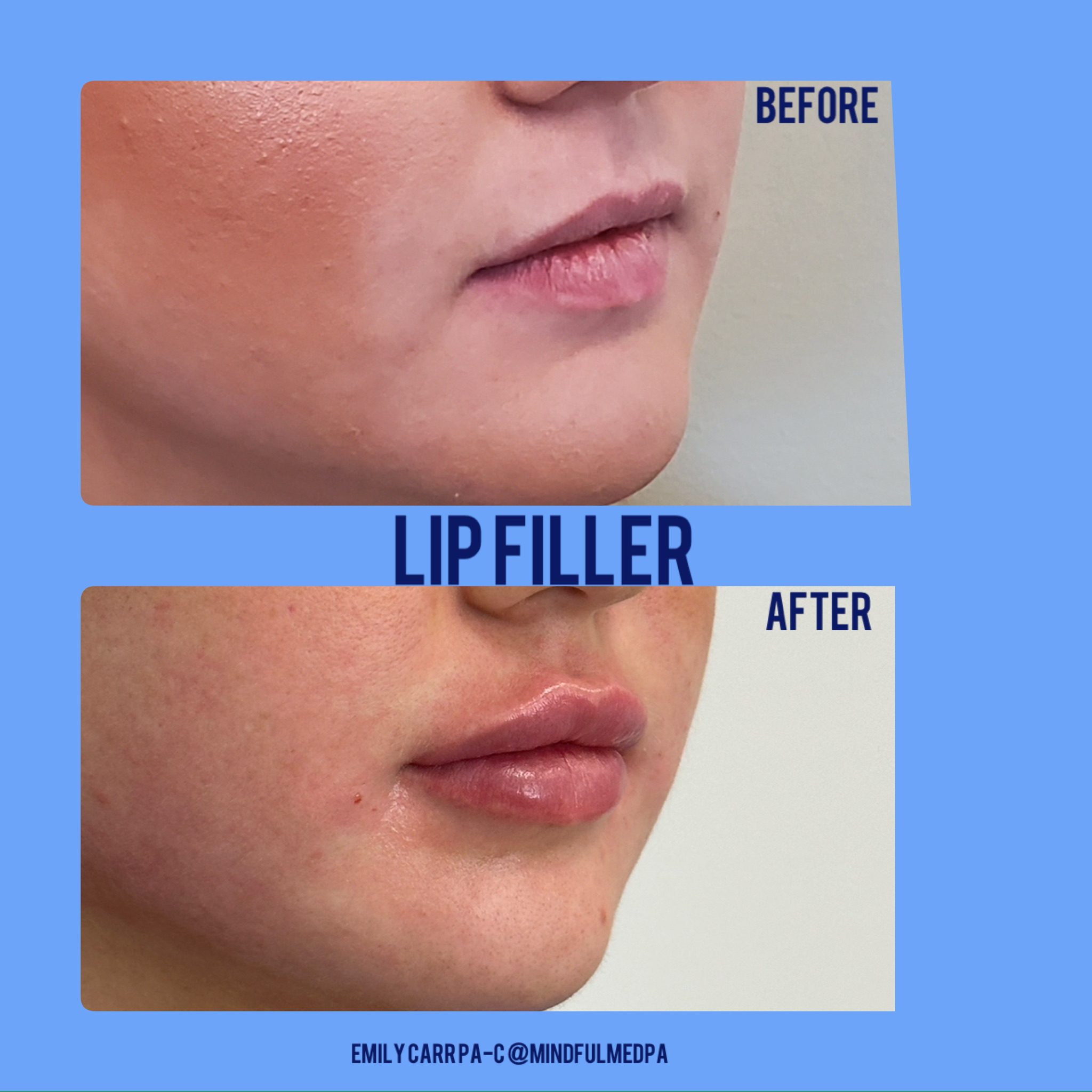 Before and after lip filler results at On-Point Aesthetics Boca Raton